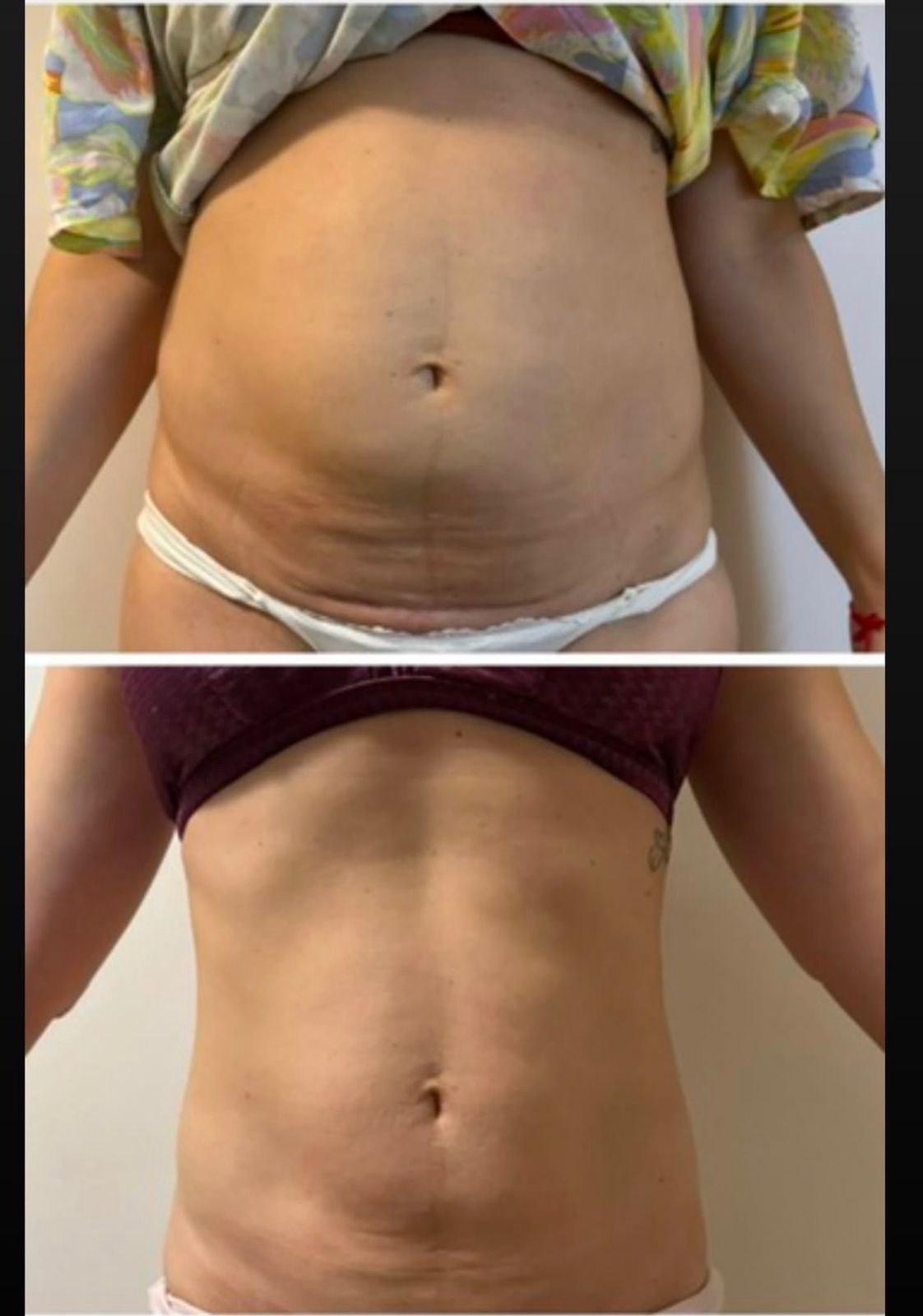 Aluna antes e depois, vista de frente: barriga projetada e depois abdômen reto
