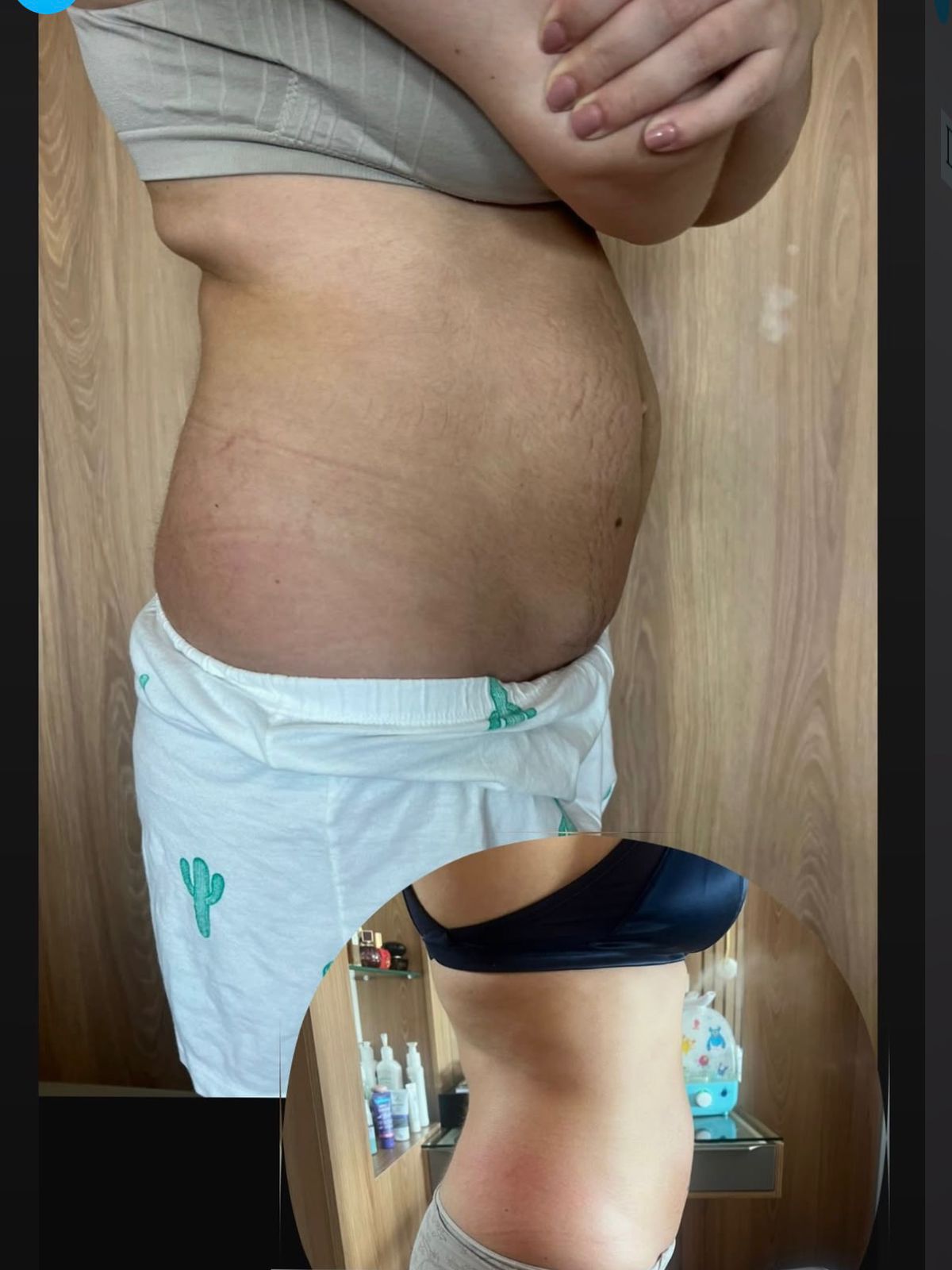 Aluna antes e depois, vista de lado: barriga projetada e depois retificada