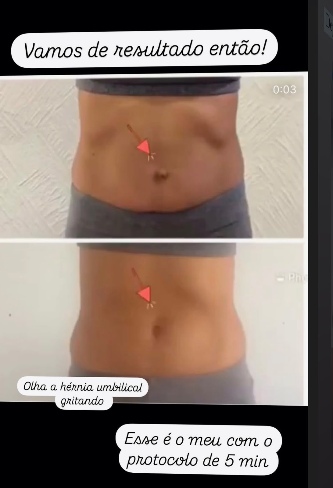 Resultado da própria Tabata com o protocolo de 5 minutos: hérnia umbilical visível e depois abdômen mais firme